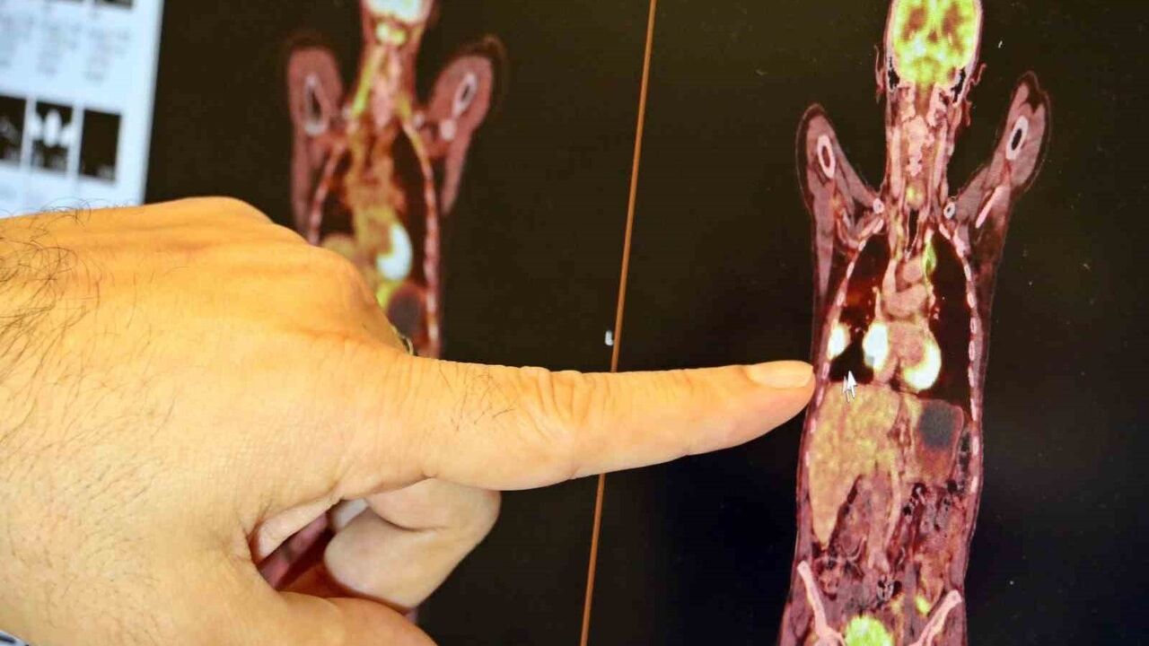 Akciğer Kanseri Tedavisinde Son Gelişmeler