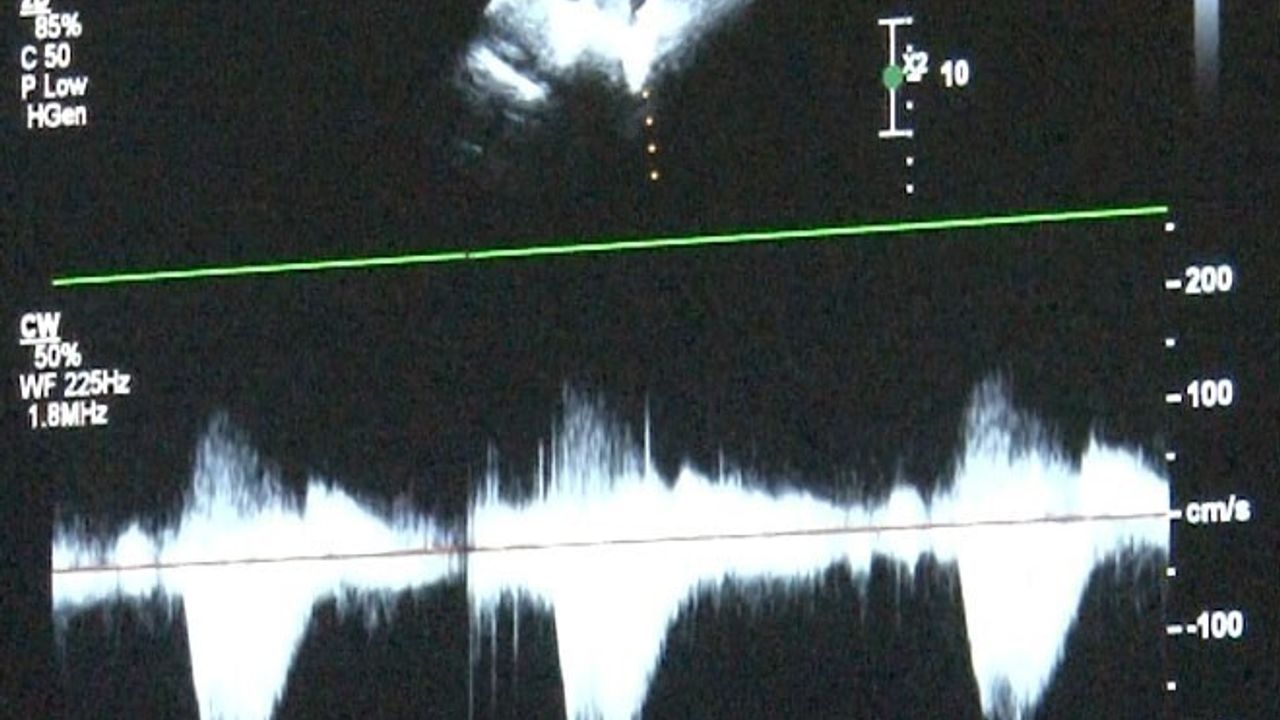 Çocuklarda Kalp Sağlığına Önem Verin