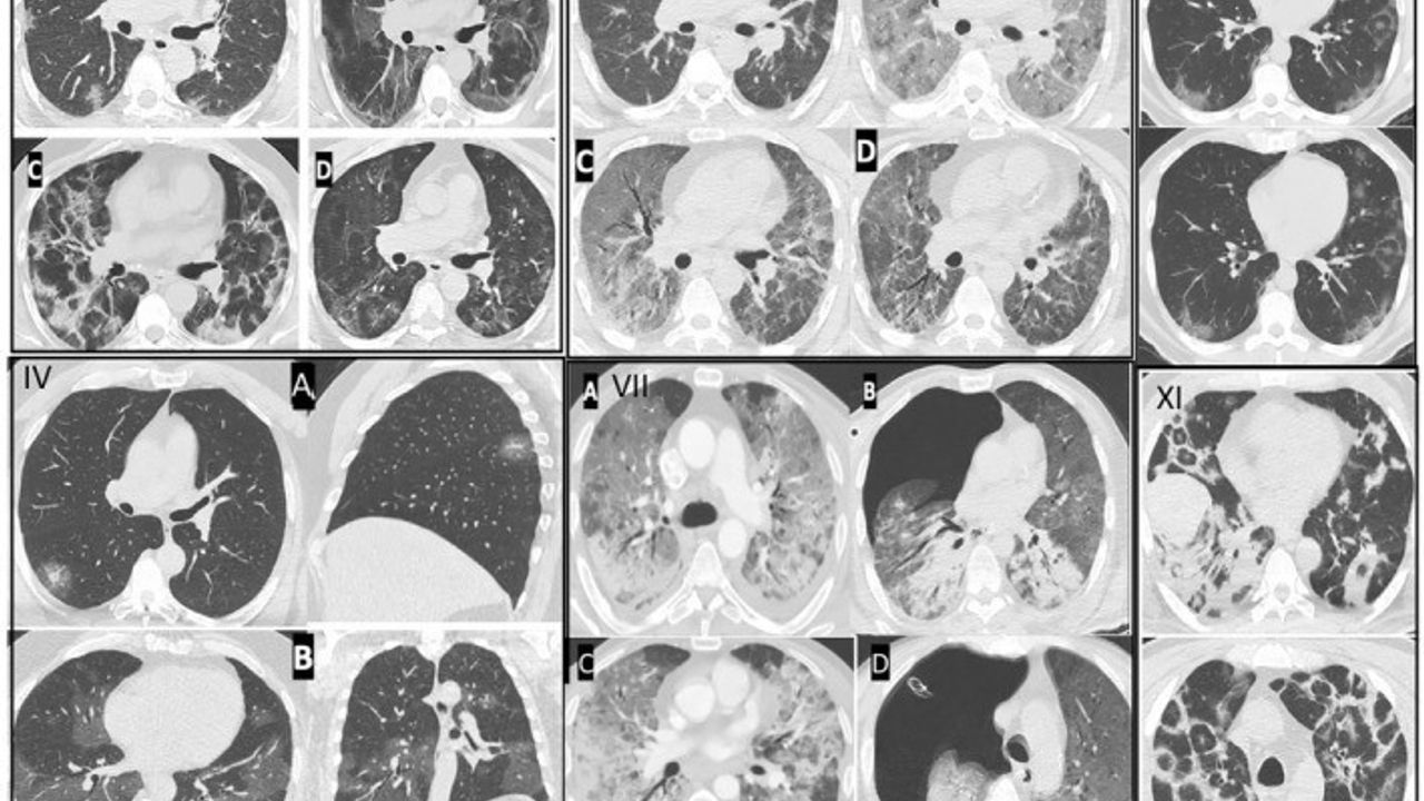 Gençlerde Ani Ölüm Vakaları Artıyor: Virüsün Etkileri