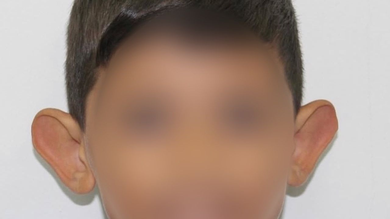 Kepçe Kulak Sorunu Çocuklarda Özgüveni Zedeliyor