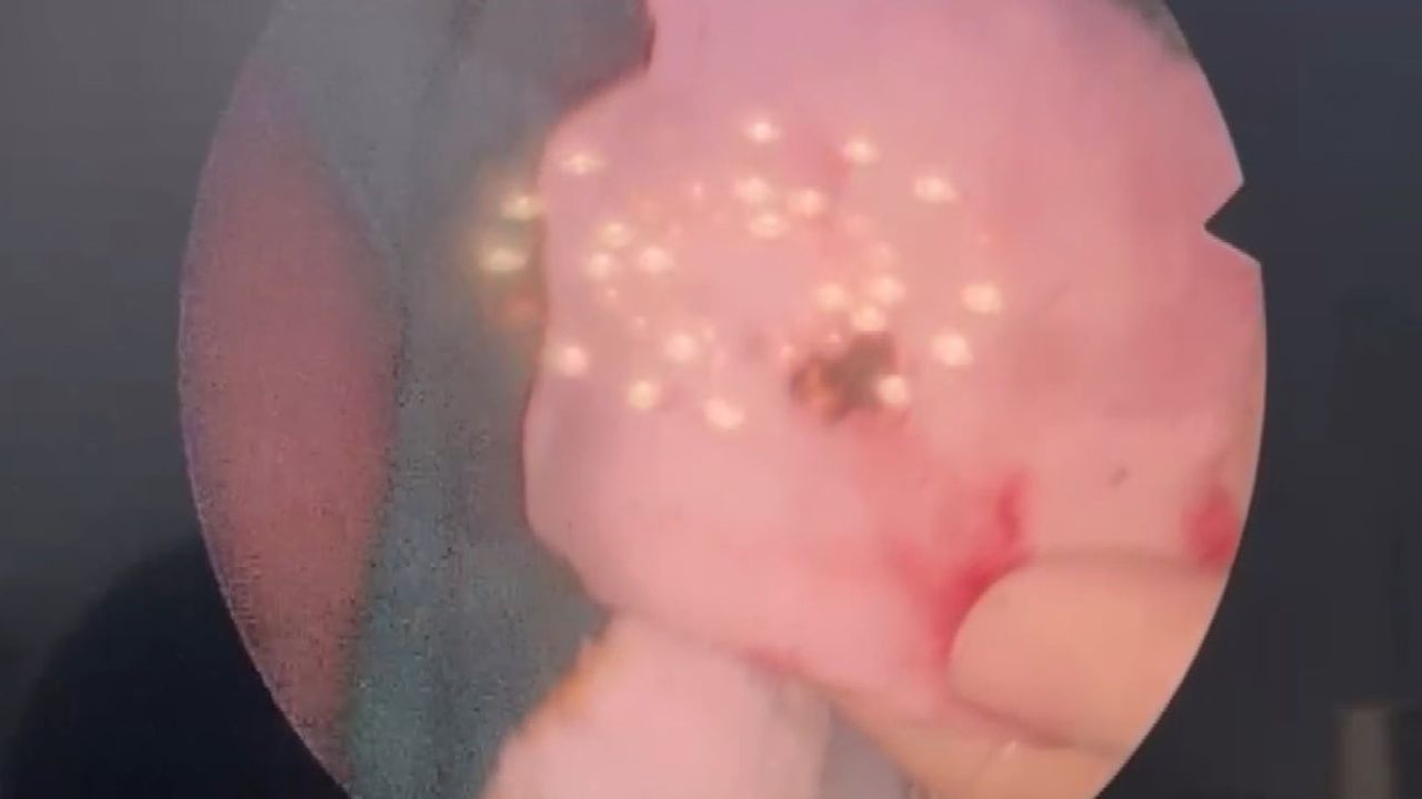 Elazığ'da Estetik Ameliyatında Taş Şaşkınlığı