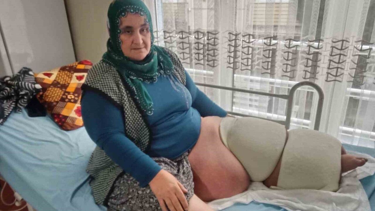 Fil Hastalığıyla Mücadele Eden Kadın Destek Bekliyor