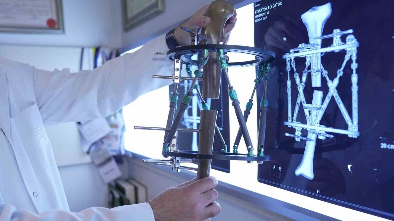 Kemik Uzatma Yöntemleri ile Boy Kısalığına Modern Çözüm