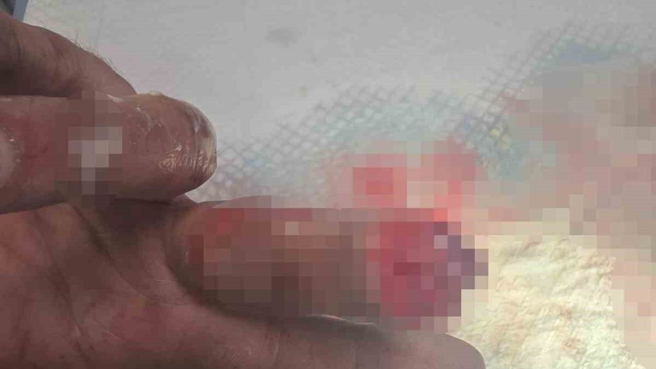 Kopan Parmağını Buz Torbasında Türkiye'ye Getirdi