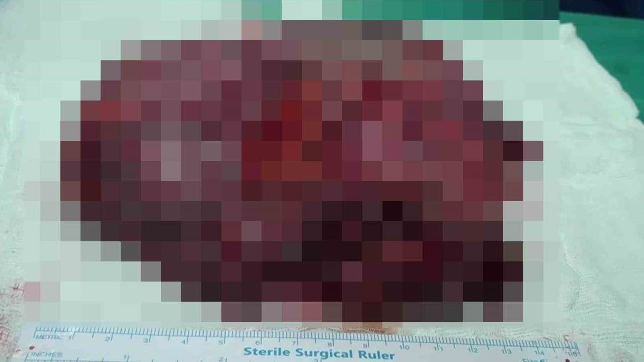 Şanlıurfa'da 25 Santimetrelik Kist Başarıyla Alındı