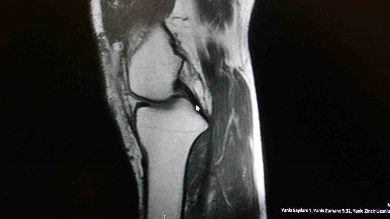 Spor Yaparken Dikkat! Ortopedi Uzmanı Önemli Uyarılarda Bulundu