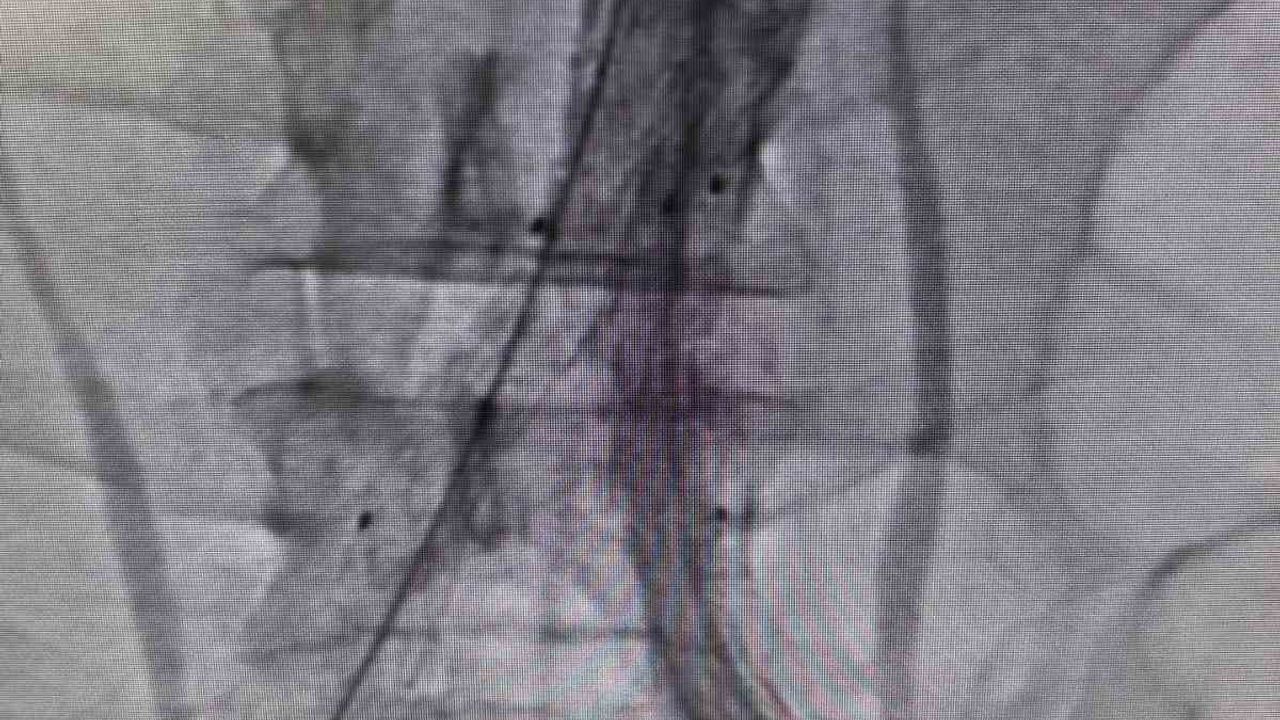 Bilecik’te Hayati Kapalı Damar Operasyonu