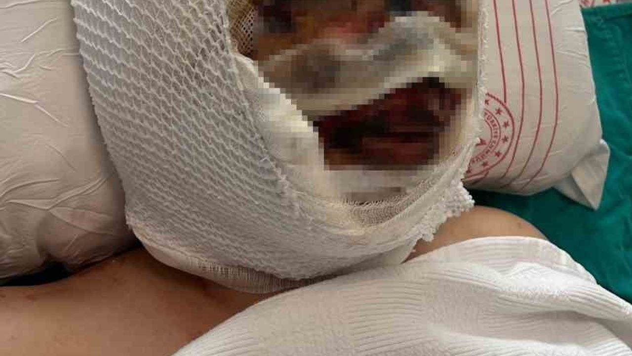 Gaziantep'te Kimyasal Madde ile Vahşet