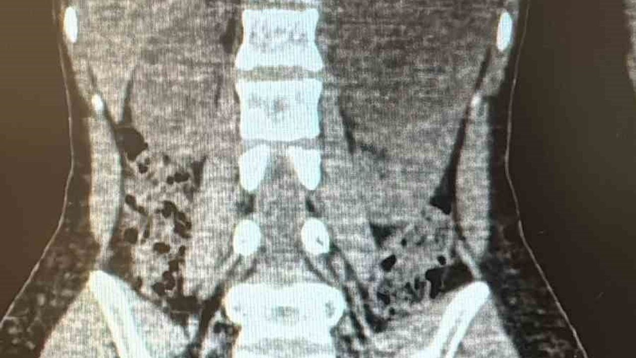 Şanlıurfa'da Kapalı Yöntemle 10 Santimetrelik Böbrek Kisti Alındı