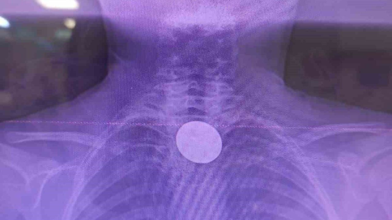 Siirt'te Boğazına Para Kaçan Çocuk Kurtarıldı