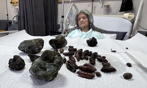 92 Yaşındaki Şerife Ay, Yuttuğu Zeytin ve Hurma Çekirdekleriyle Ameliyat Oldu