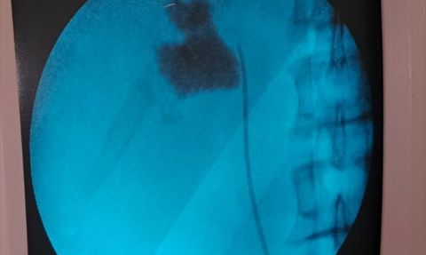 Kırşehir'de Kapalı Ameliyatla 6 Santimetrelik Taş Alındı