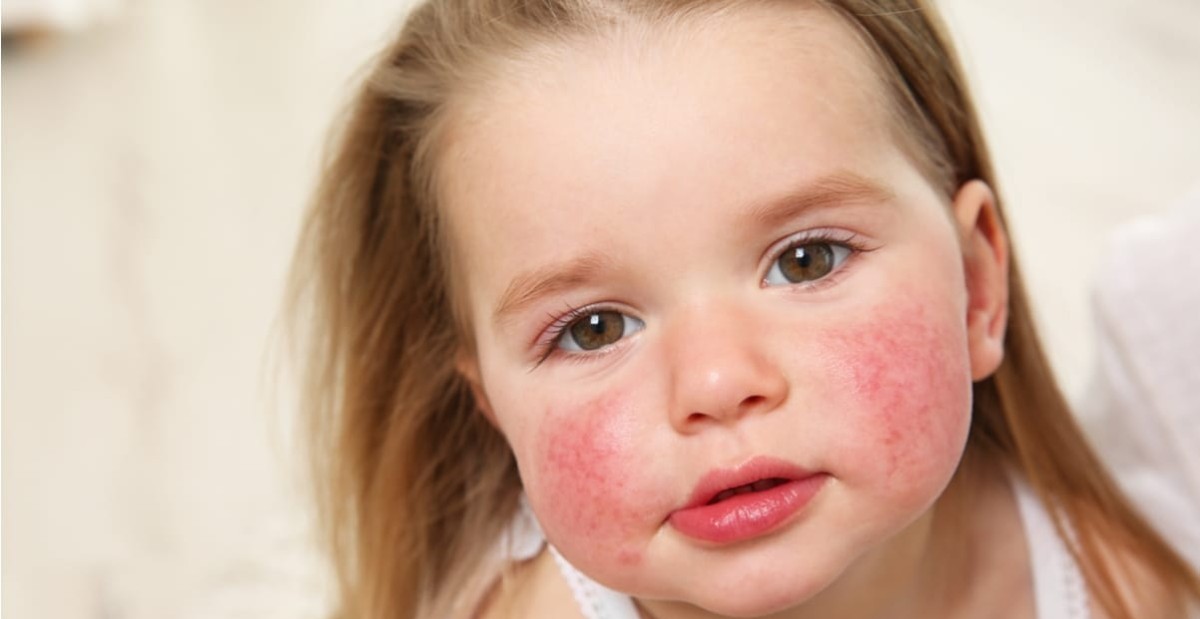 Çocuklar bahar aylarında Beşinci Hastalığa daha sık yakalanıyor