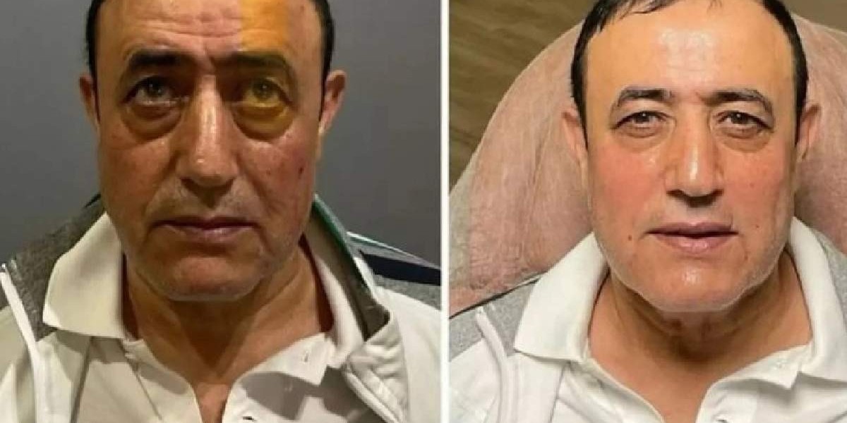 mahmut tuncer estetikli hali