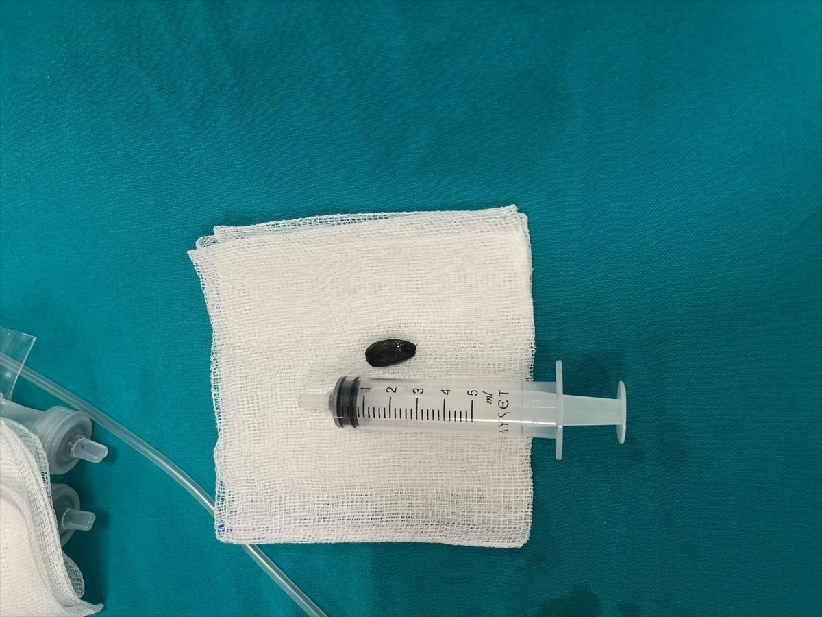 Batman'da akciğerine çekirdek kabuğu kaçan 15 aylık bebek ameliyatla sağlığına kavuştu.