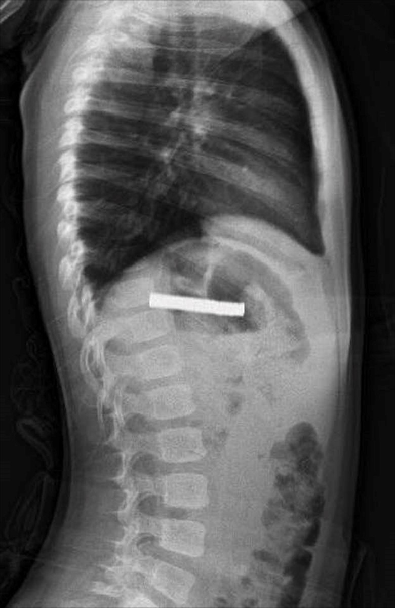 Elazığ'da 3 yaşındaki çocuğun yuttuğu ve yemek borusunu tıkayan 19 mıknatıs, Fırat Üniversitesi...