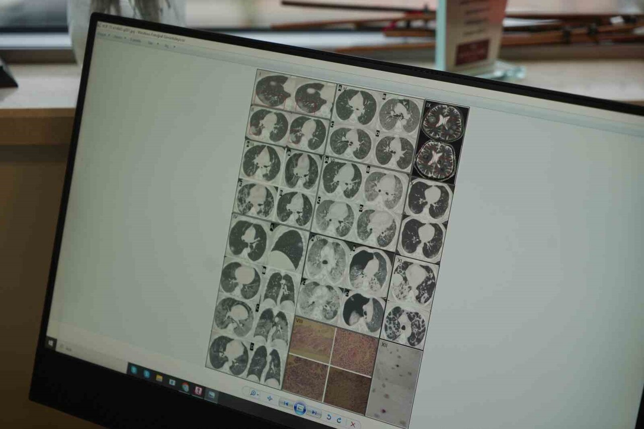 GENÇLERDE ANİ ÖLÜMLER ARTIYOR: 'NEDENİ İSE VİRÜSÜN DAMARLARDA BIRAKTIĞI HASAR"