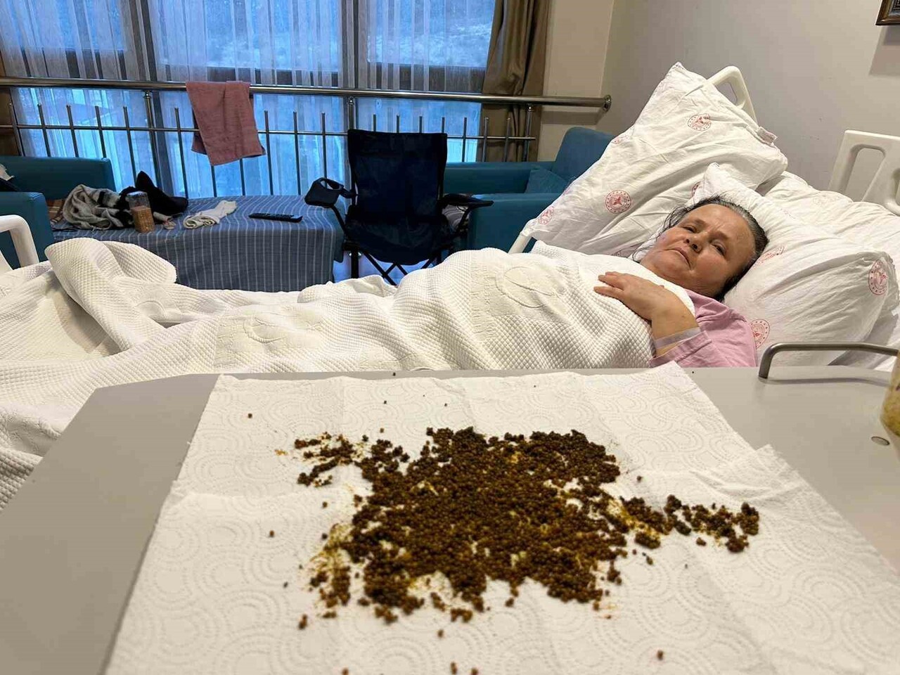 KARIN AĞRISI ŞİKAYETİYLE HASTANEYE BAŞVURAN 70 YAŞINDAKİ AYŞE ÇOBANLAR’IN SAFRA KESESİNDEN TAM 20...