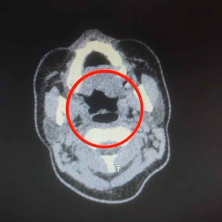KAYSERİ'DE ULUSLARARASI UYUŞTURUCU MADDE TİCARETİ YAPAN KURYENİN MİDESİNDE 50 ADET KAPSÜL ŞEKLİNDE...