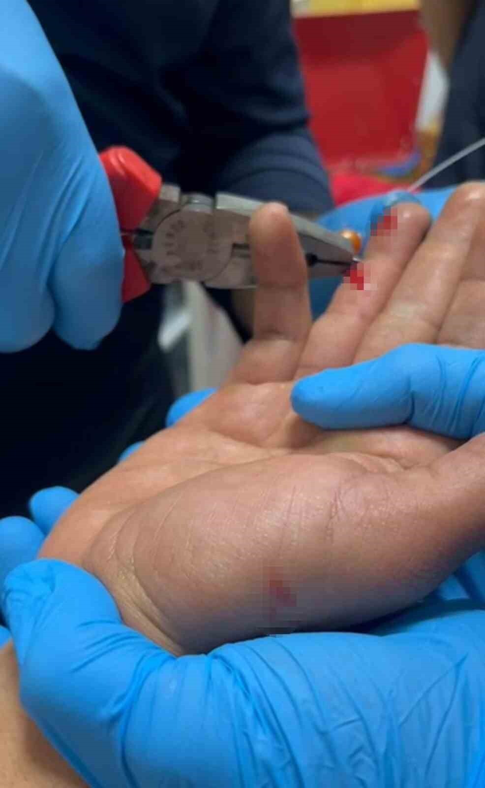 ADIYAMAN'IN KAHTA İLÇESİNDE BALIK AVLAMAYA GİDEN ŞAHSIN PARMAĞINA SAPLANAN İĞNE, DOKTORLAR...