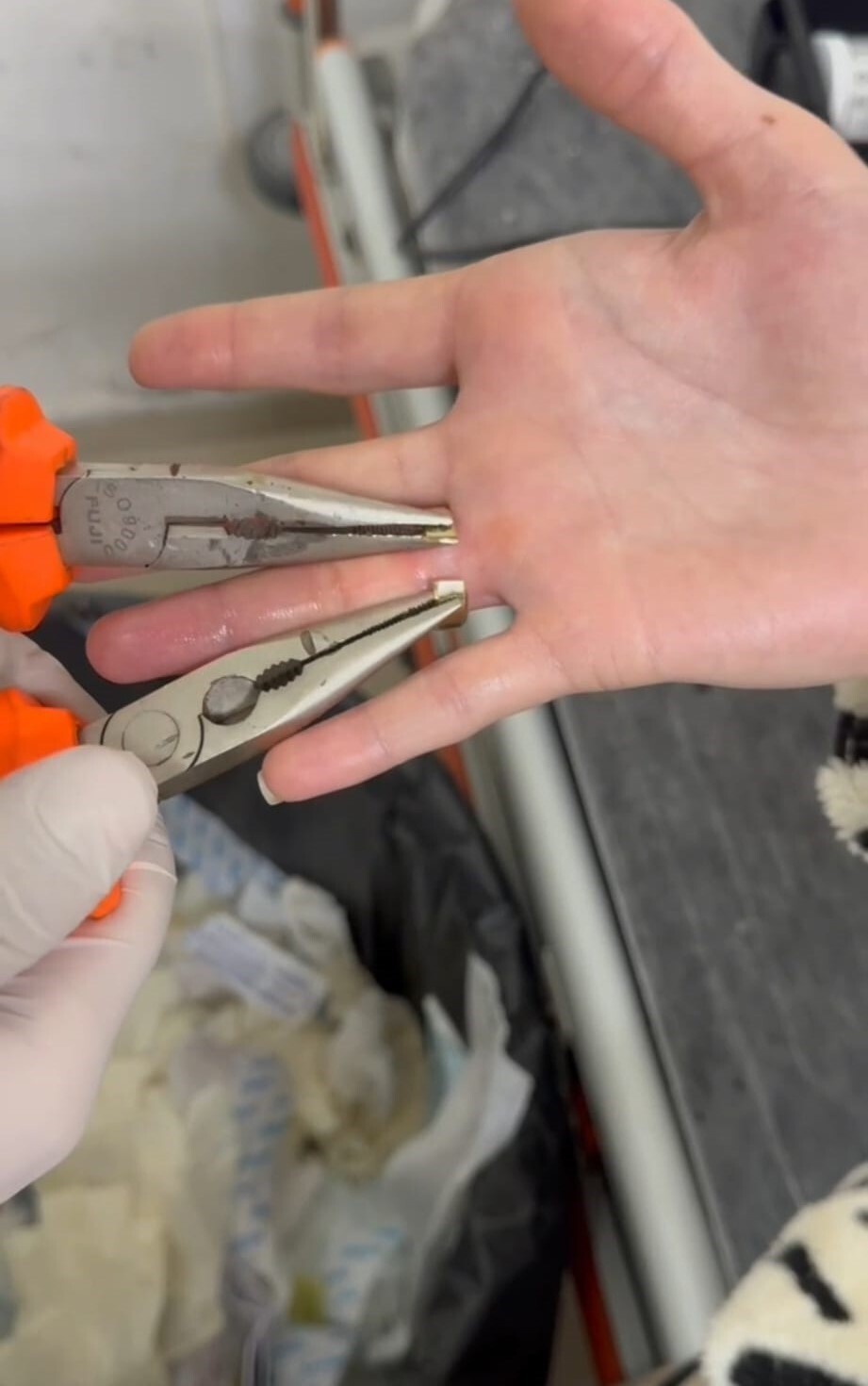 BATMAN’DA PARMAĞA SIKIŞAN İKİ YÜZÜK 'SPİRAL MAKİNE' İLE ÇIKARILDI