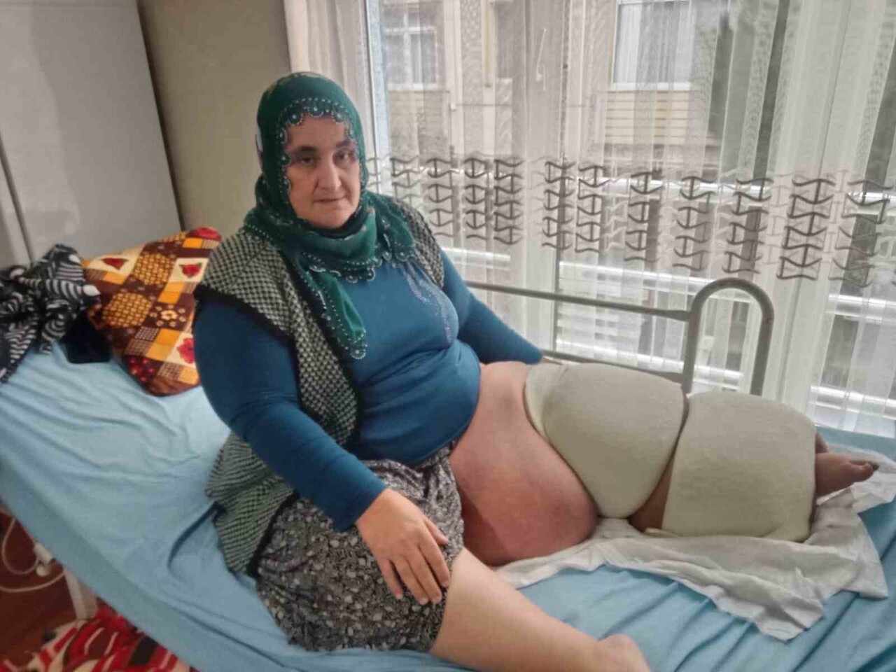 MERSİN'İN TARSUS İLÇESİNDE YAŞAYAN CENNET KARABACAK, FİL HASTALIĞIYLA 35 YILDIR MÜCADELE EDEREK...