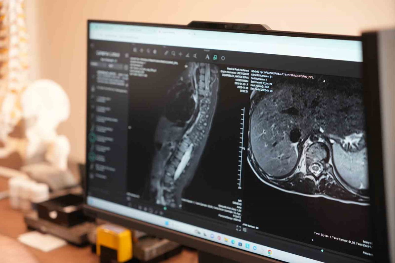 OMURGANIN YANA DOĞRU EĞİLMESİYLE ORTAYA ÇIKAN SKOLYOZ, ÖZELLİKLE ÇOCUKLUK VE ERGENLİK DÖNEMİNDE...