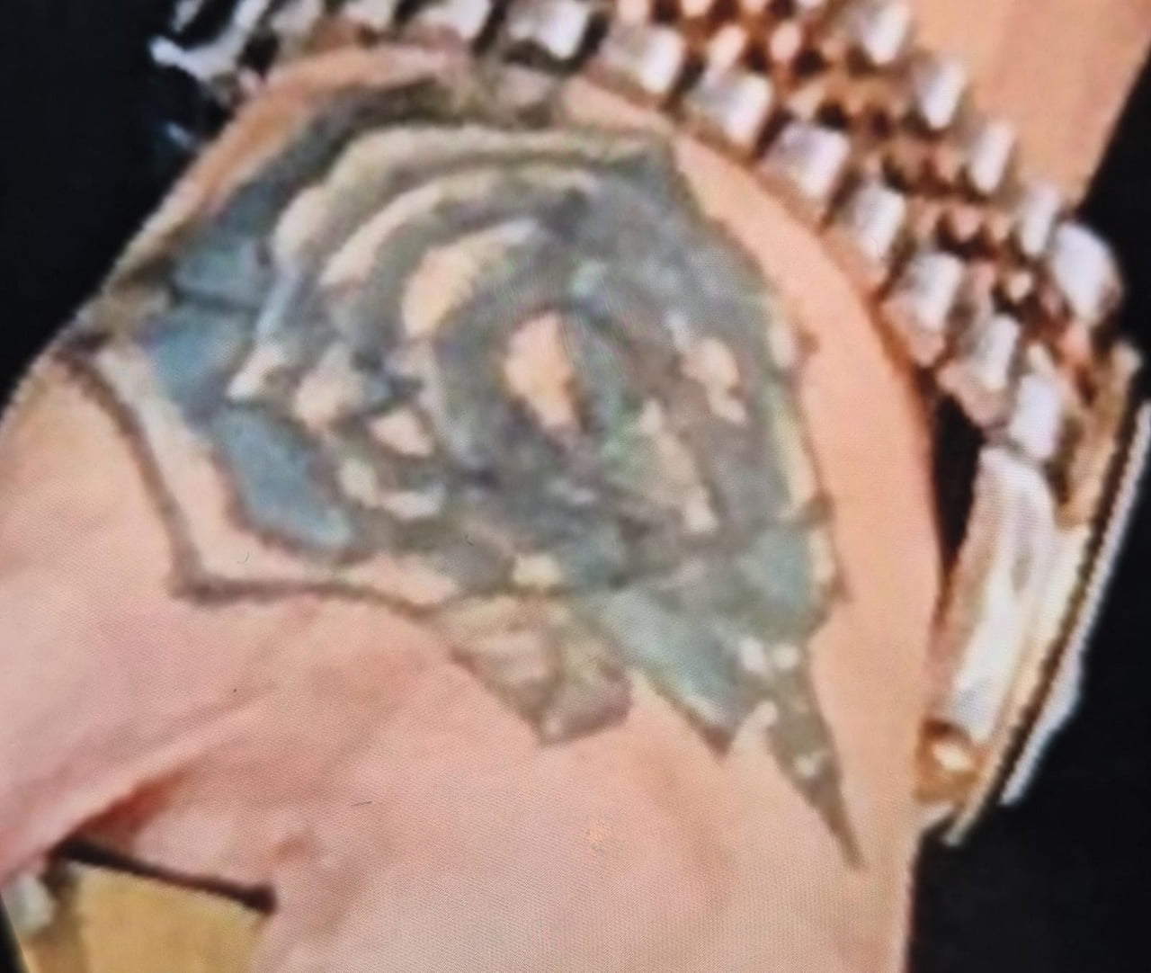 BİR GÜZELLİK MERKEZİNDE ELİNDEKİ DÖVMEYİ SİLDİRMEK İSTEYEN YASİN TAŞ’IN SOL ELİNDE HATALI UYGULAMA...