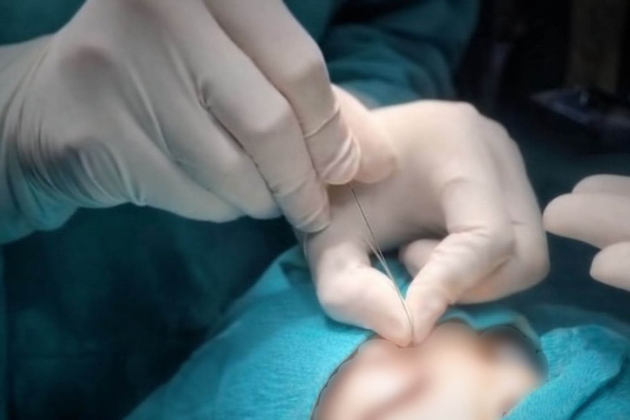 ÇUKURCA DEVLET HASTANESİ'NDE GÖZ HASTALIKLARI ALANINDA İLERİ DÜZEY TEDAVİ VE CERRAHİ UYGULAMALAR...