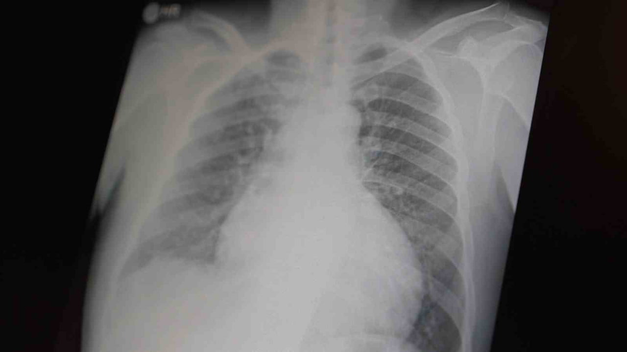 GÖĞÜS HASTALIKLARI UZM. PROF. DR. ŞEVKET ÖZKAYA, TÜM DÜNYADA ÇOCUK VE GENÇLERİ ETKİLEYEN İKİ...