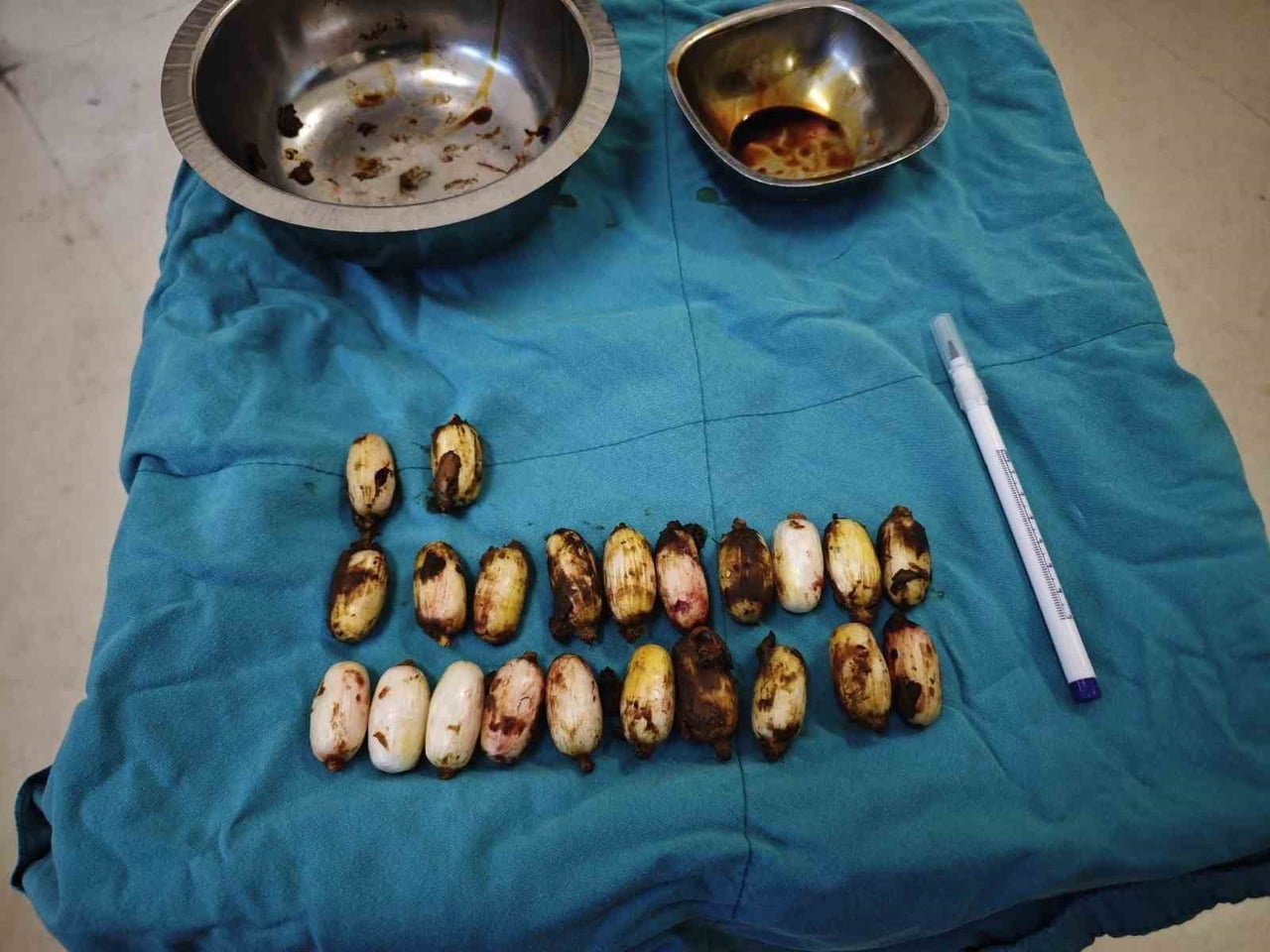 YURTDIŞINDAN ESKİŞEHİR’E 44 KAPSÜL UYUŞTURUCU MADDEYİ MİDESİNDE SOKMAYA ÇALIŞAN YABANCI UYRUKLU...